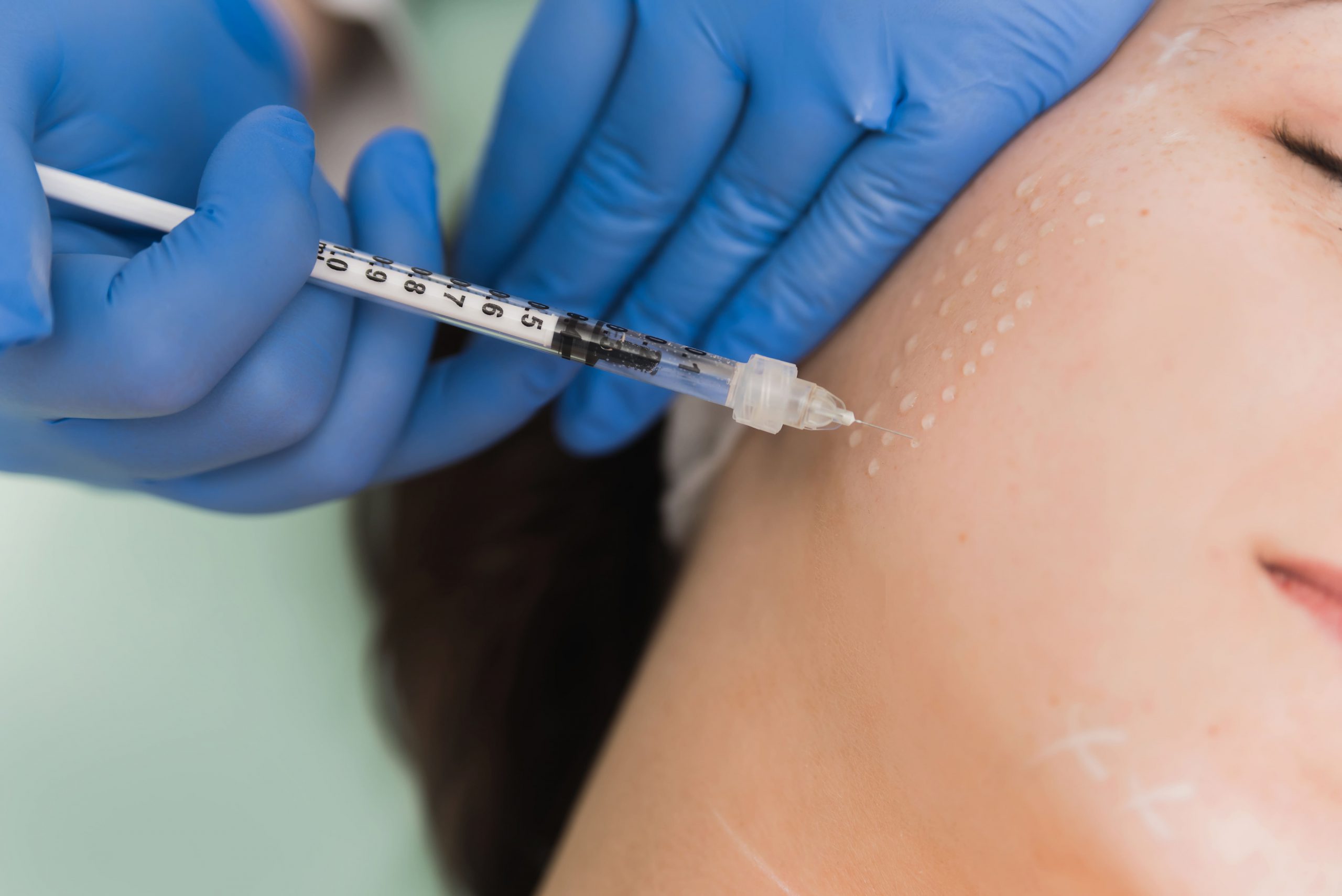 Mezoterapia – preparaty wykorzystywane podczas zabiegu