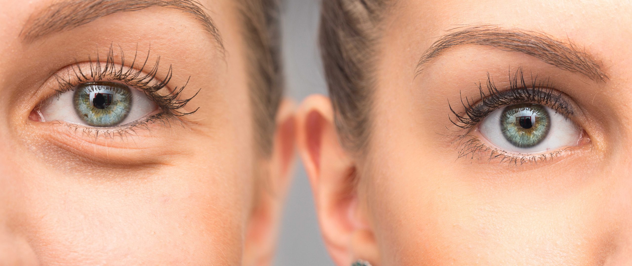 Skuteczność nowoczesnej terapii enzymatycznej w redukcji worków pod oczami