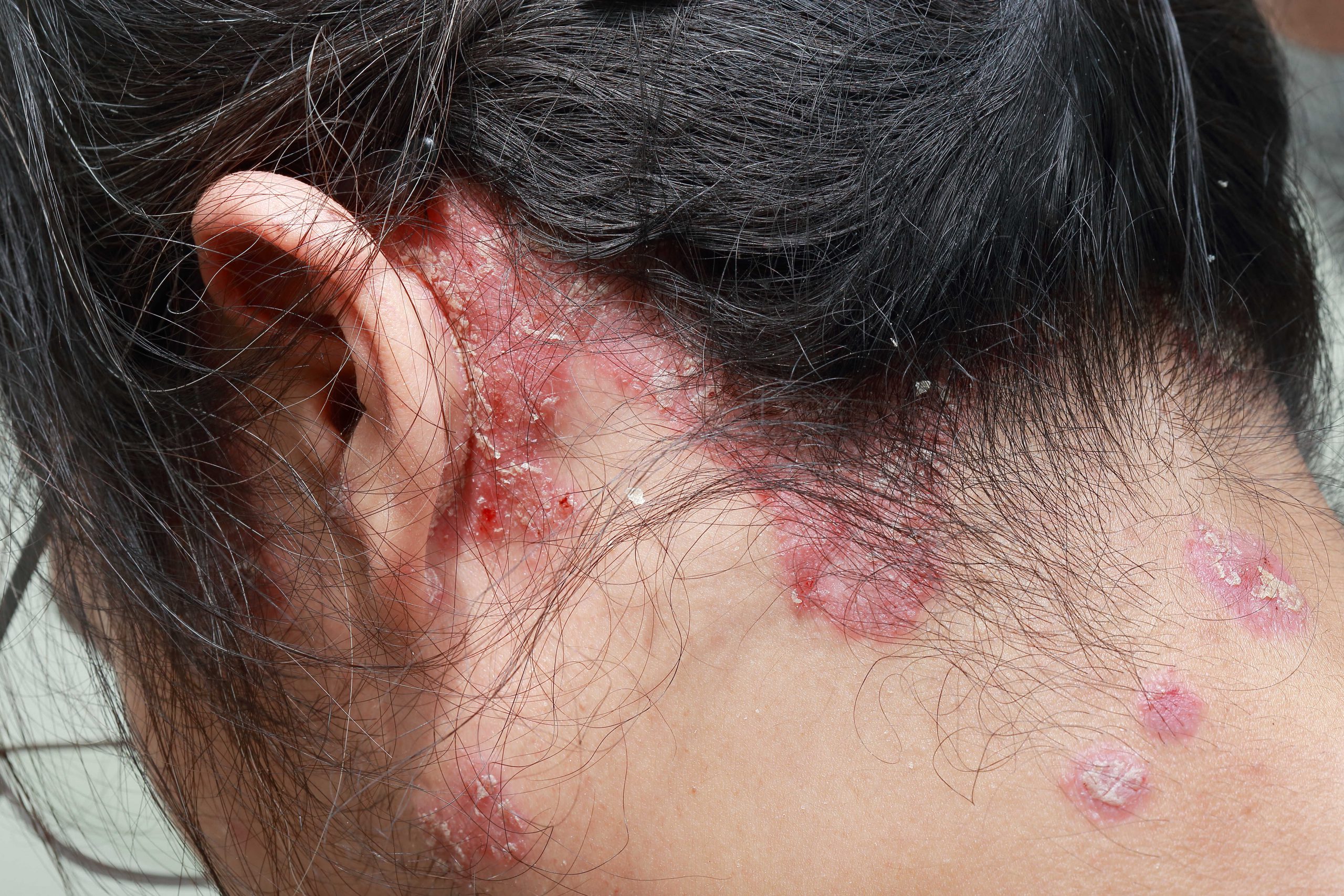 Choroby autoimmunologiczne w obszarze owłosionej skóry głowy