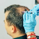 Mezoterapia owłosionej skóry głowy