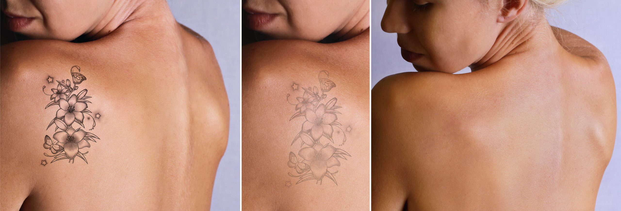 Skuteczne i bezpieczne usuwanie tatuaży i makijażu permanentnego (cz. 3) – metoda R20, ilość zabiegów i co po nich