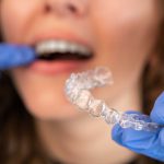 Bez jakich zabiegów stomatologicznych nie wymodelujemy ust?