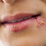 Powikłania po powiększeniu i modelowaniu ust – nietypowy przebieg choroby przy zakażeniu wirusem opryszczki