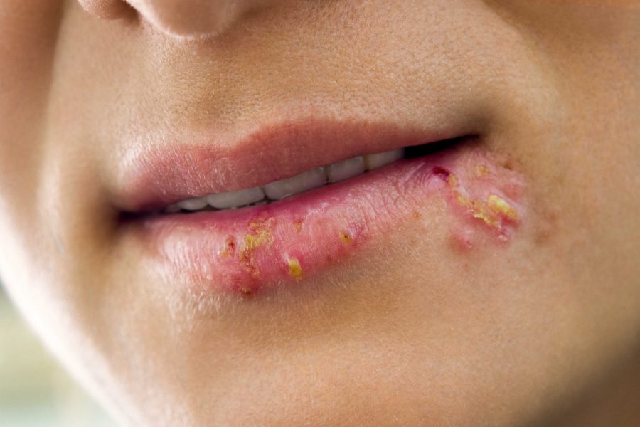 Powikłania po powiększeniu i modelowaniu ust – nietypowy przebieg choroby przy zakażeniu wirusem opryszczki