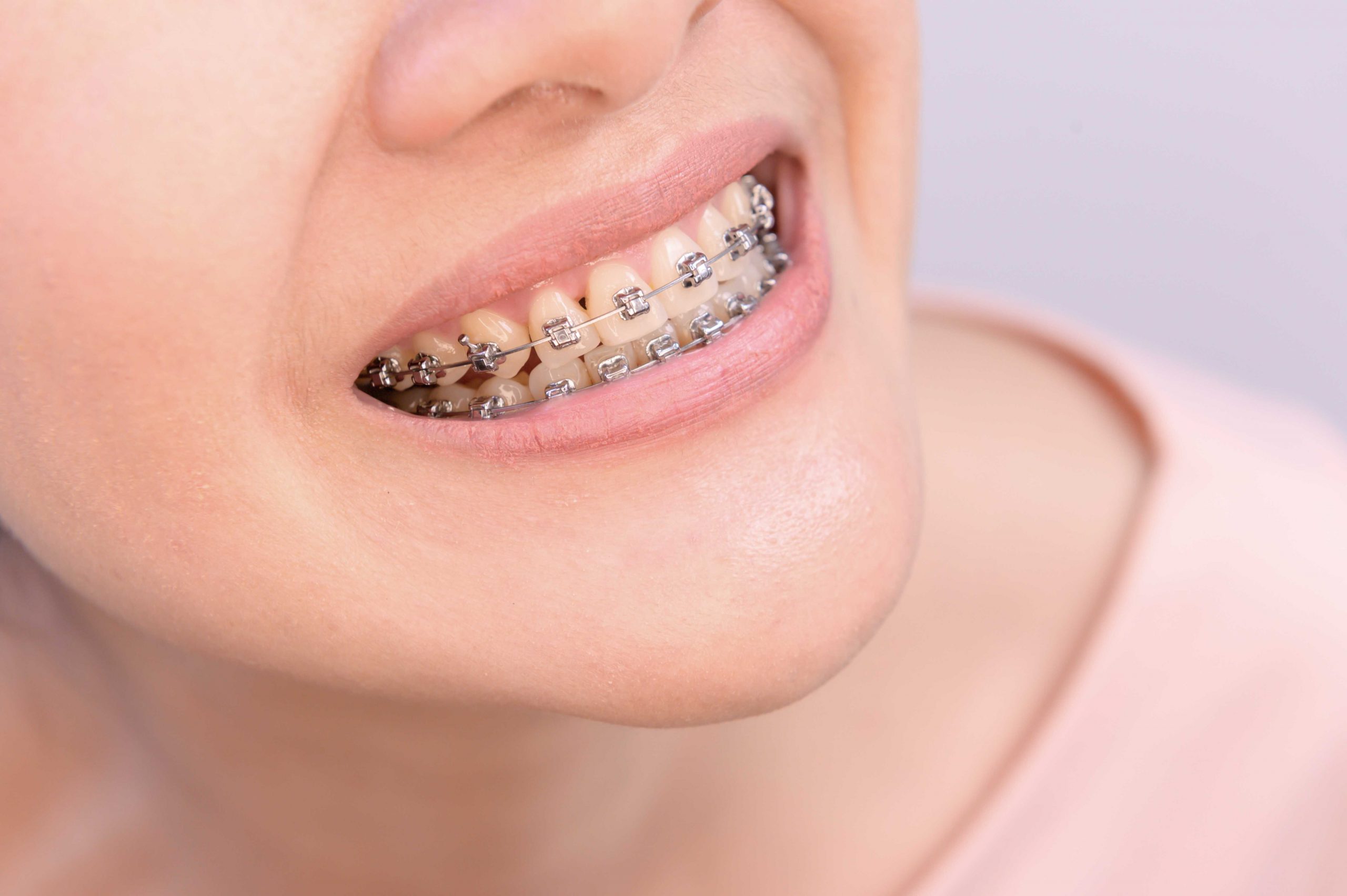 Modelowanie ust – kaniula i aparat ortodontyczny
