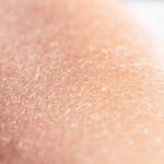 Jak poradzić sobie z suchą skórą? | TOP 6 zabiegów nawilżających