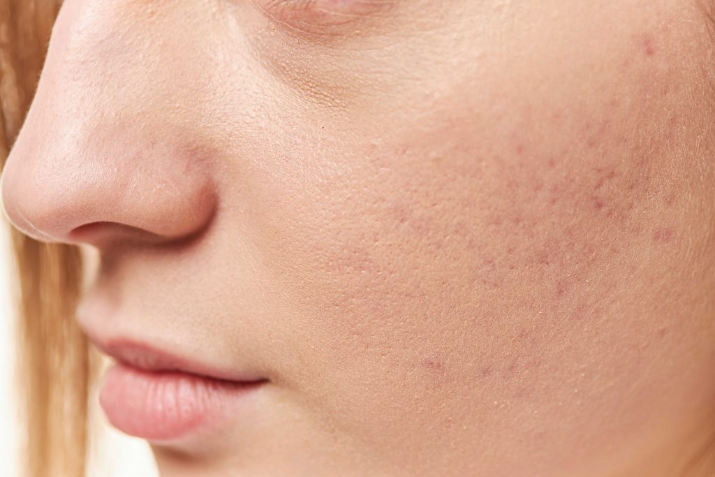 pielęgnacja skóry twarzy kwasy