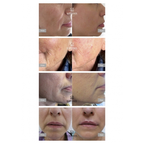 Karisma Rh Collagen Face (1x2ml)