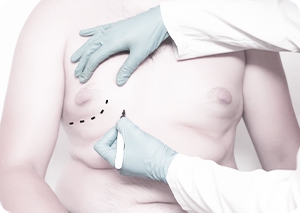 aqualyx- Jaki preparat najlepiej sprawdzi się w przypadku przerostu tkanki tłuszczowej, na klatce piersiowej, u mężczyzn? 